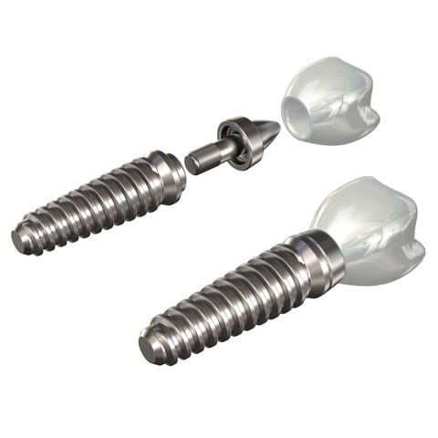 Dental implants
