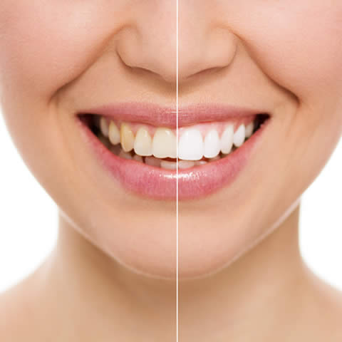 Lady's face, focusing on the smile, split half and half for before and after.